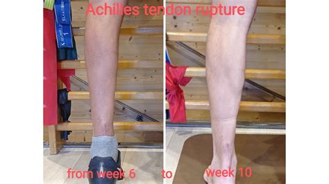 Achilles Tendon Rupture Week Rehabilitation Protocol