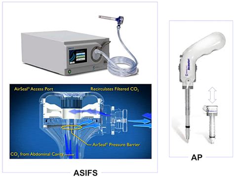 Laparoscopic Toupet Fundoplication using an Air Seal Intelligent Flow System and Anchor Port in ...