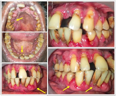 Chronic periodontitis: a case report - Kauvery Hospital