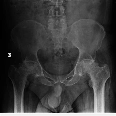 Ap Pelvis X Ray Labeled