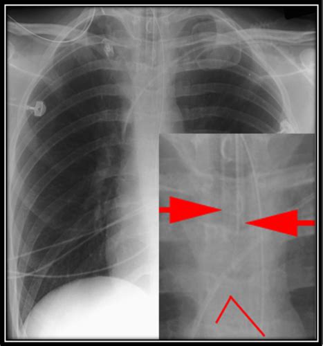 Chest Xray Flashcards Quizlet