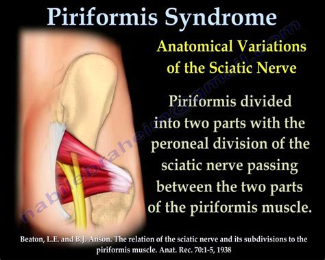 Piriformis Syndrome , sciatica - Everything You Need To Know - Dr ...