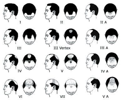 2020 hair loss: Types of Baldness