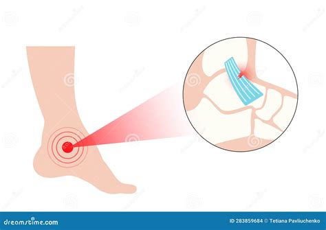 Sprained Ankle Injury Stock Vector Illustration Of Muscle