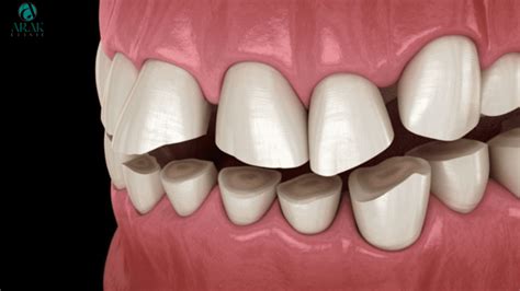 Teeth Grinding: Causes, Effects, and Solutions - Arak Clinic