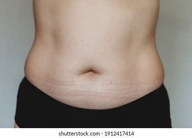 Womans Belly Stretch Marks Stock Photo 1912417414 Shutterstock