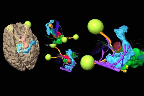 Augmented Reality Assisted Navigation In Neuro Oncological Surgery