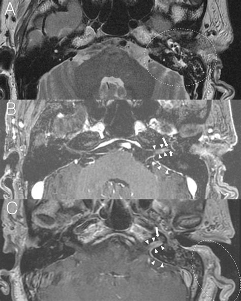 A Representative Case Of Ramsay Hunt Syndrome With Mastoid Effusion On Download Scientific