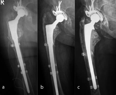 Aseptic Loosening Of A Mutars Rs Stem In Case Of A Paprosky Iiia