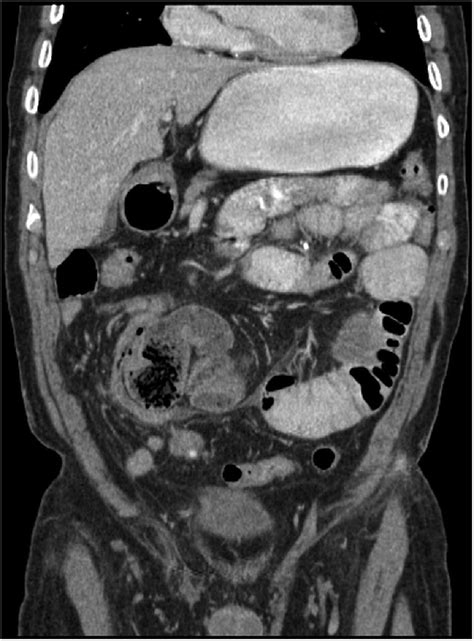 Abdominal Cocoon Idiopathic Sclerosing Encapsulating Peritonitis Bmj