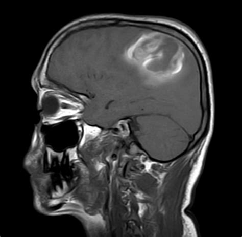 Pediatric Brain With Hemorrhagic Mass Philips Mr Body Map