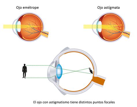 Resumen De Art Culos Como Se Corrige El Astigmatismo Actualizado