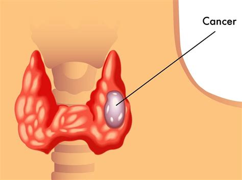 Medullary Thyroid Cancer Guidelines: New Risk Classes and More