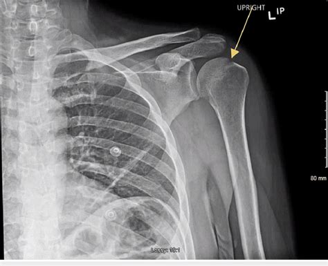 Radiographic Findings Of The Left Shoulder Description Download