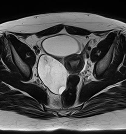 Ovarian Torsion Radiology Reference Article Radiopaedia Org