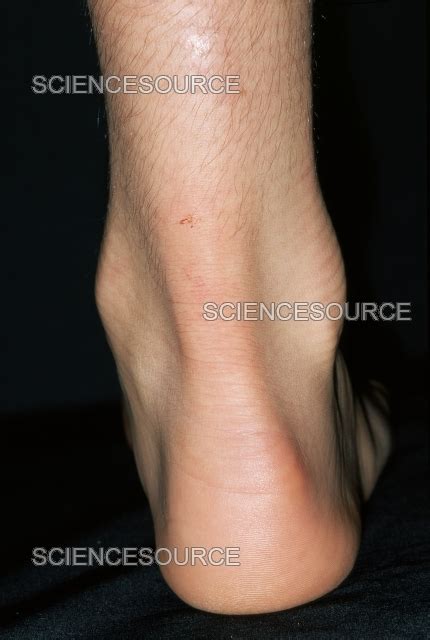 Swollen Achilles Tendon Stock Image Science Source Images