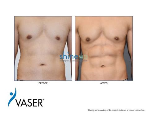 Male Liposuction Ab Etching With Liposuction L Shinemd