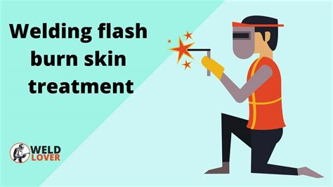 Welding Flash Burn Skin Treatment Tips And Tricks Weldlover