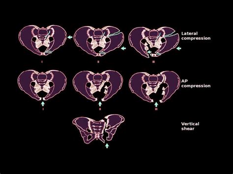 [figure Pelvic Ring Injuries Image Courtesy Dr Chaigasame