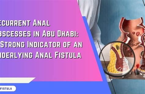 Causes Of Anal Fistula Complete Guide For Prevention Care