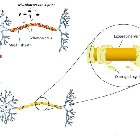 Neuropathogenesis Of Mycobacterium Leprae M Leprae Binds To Myelin