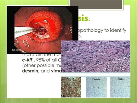 Ppt Gists Gastrointestinal Stromal Tumor Powerpoint Presentation Free Download Id 2046838