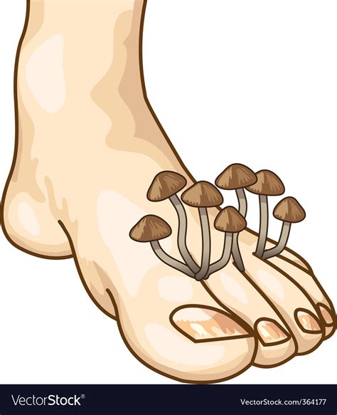 Mycosis Between The Toes Royalty Free Vector Image