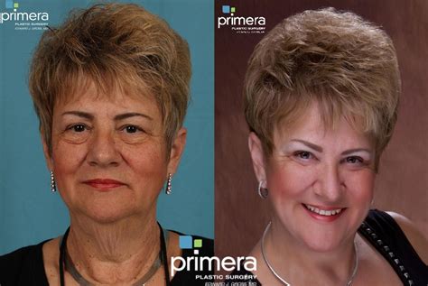 Blepharoplasty Before And After Pictures Case 72 Orlando And Tampa