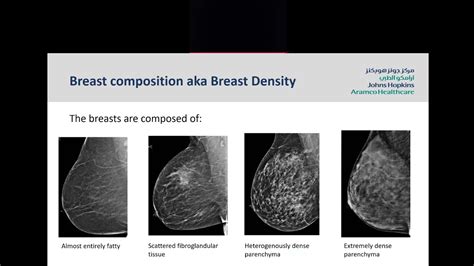 Screening Mammogram Understanding Your Mammogram Report Youtube