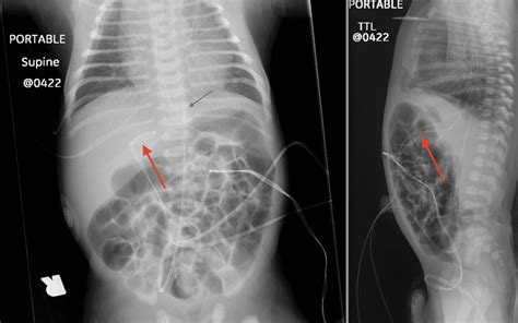 Misplaced Lines And Tubes | UAMS Department of Radiology