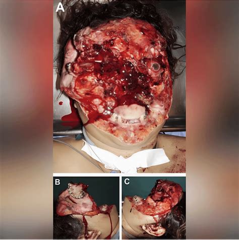 Severe Facial Trauma And Repair Rmedicalgore