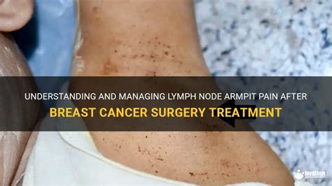 Understanding And Managing Lymph Node Armpit Pain After Breast Cancer ...