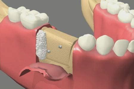 Bone Grafting Sinus Lifts Wood Street Specialists