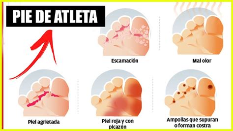 Tipos De Hongos En Los Pies