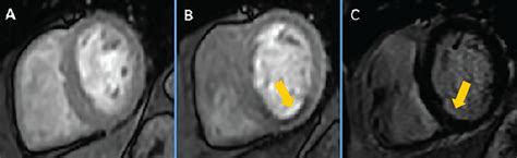 Stress Testing And Noninvasive Coronary Imaging Whats The Best Test