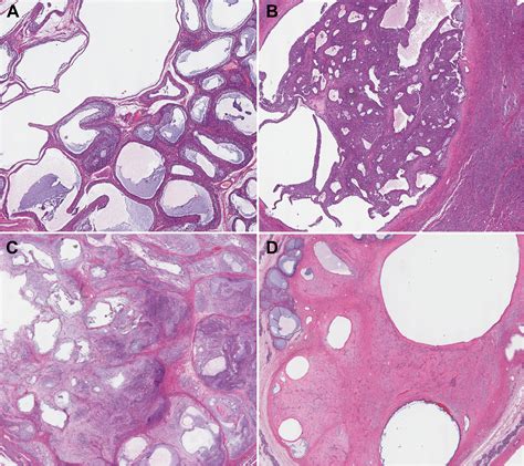 Testicular Juvenile Granulosa Cell Tumors Demonstrate Recurrent Loss Of