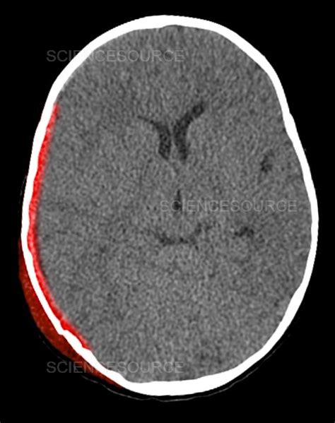 Subdural Hematoma Ct Scan Stock Image Science Source Images