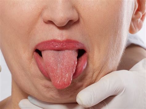 Tingling Tongue Causes And When To See A Doctor 52 Off