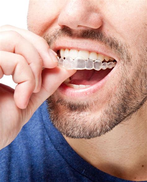 Get Best Alternative For Dental Braces By Invisalign Providers Melbourne