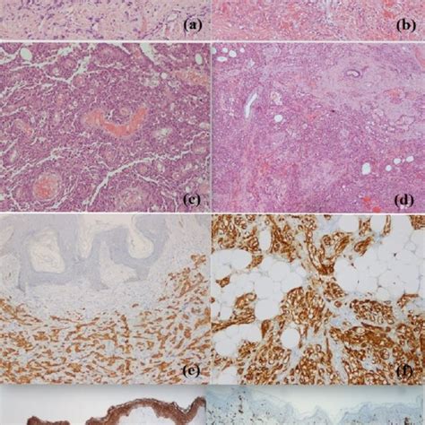 A B Hematoxylin And Eosin Staining 10 Angiosarcoma Low Grade