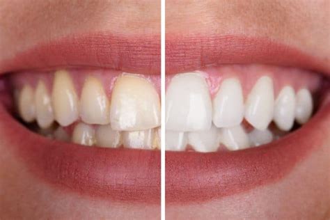 Whiten Your Teeth Naturally At Home Absolute Dental