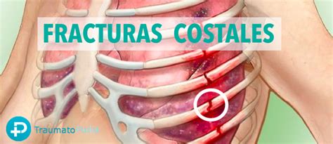 Costillas Rotas Tratamiento Con Fisioterapia Respiratoria Traumatopedia