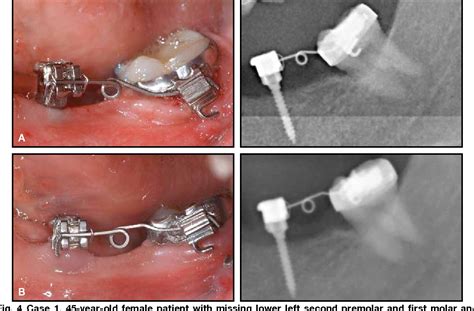 Figure From Preprosthetic Molar Uprighting Using Skeletal Anchorage