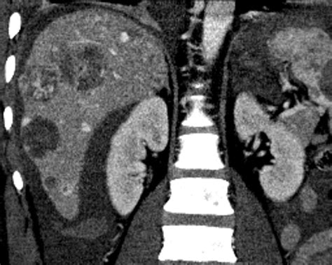 Liver Atlas Diagnosis Angiosarcoma