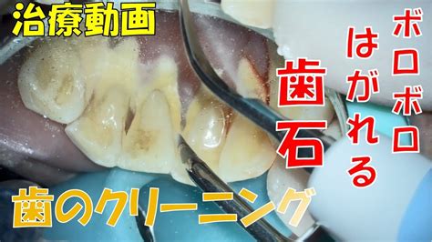 ボロボロとれる歯石取り。歯のクリーニング動画。 Teeth Cleaning Removing Tartar Youtube