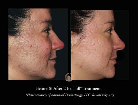 Bellafill Filler To Fill In Scars Advanced Dermatology