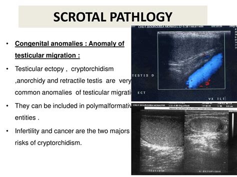 Ppt Scrotal Sonography Revisited Powerpoint Presentation Free