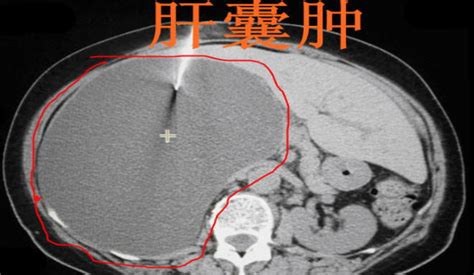 肝囊肿的症状图片 肝囊肿图片大全 肝囊肿 39疾病百科