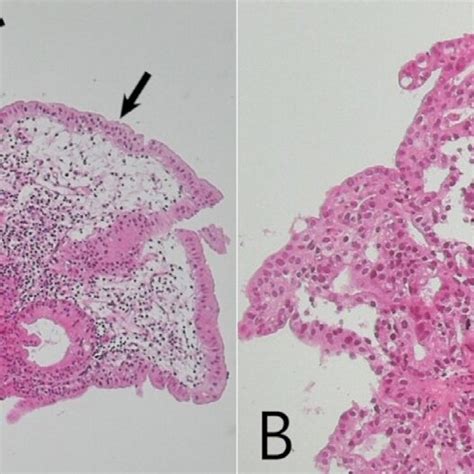 Histopathological Findings A The Biopsy Specimen Showed A Tumor