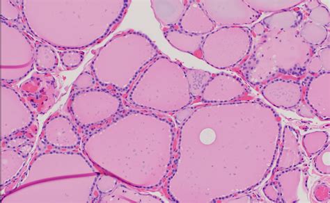 Normal Thyroid Follicular Cells – My Endo Consult